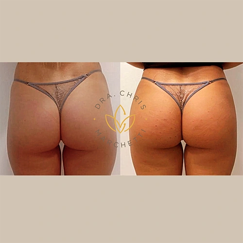 Antes e depois de harmonização de glúteos