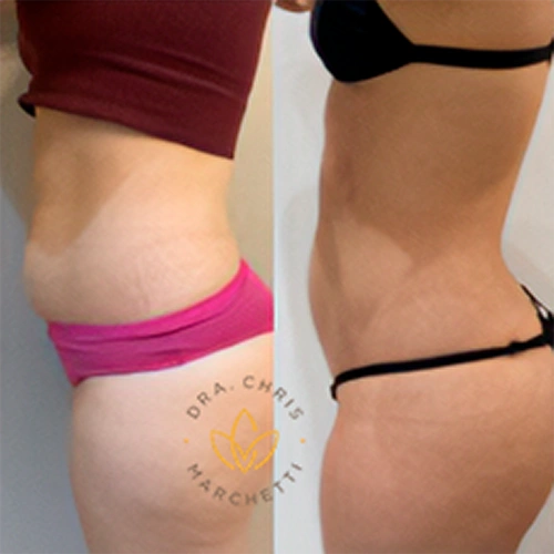 Antes e depois — redução de gordura localizada