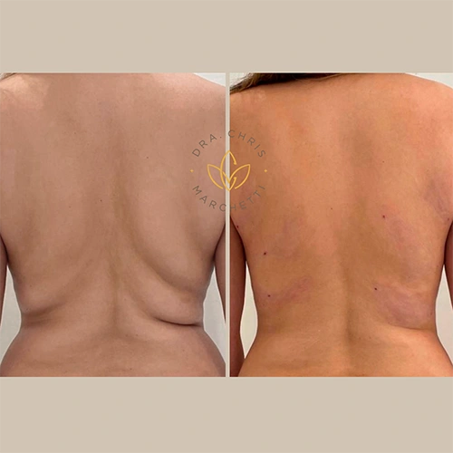 Antes e depois — redução de gordura localizada