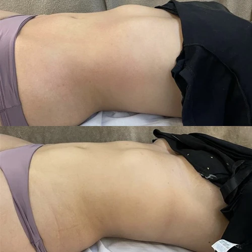 Antes e depois Slim Lipodetox®