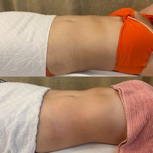 Antes e depois Slim Lipodetox®