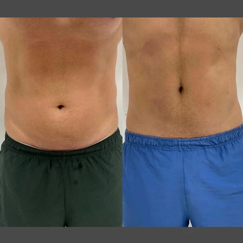 Antes e depois Slim Lipodetox®