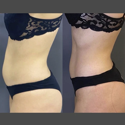 Antes e depois Slim Lipodetox®