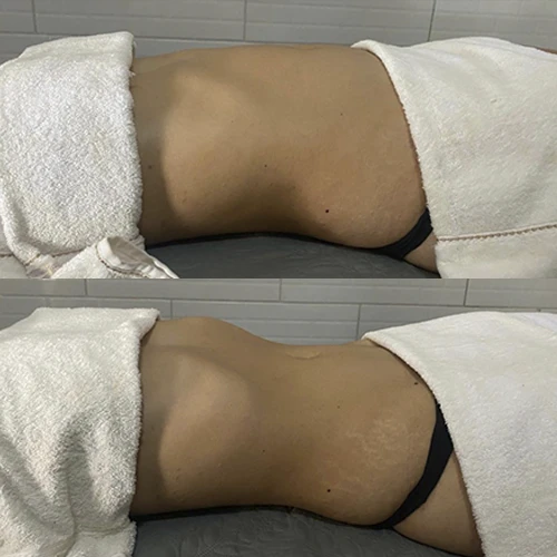 Antes e depois Slim Lipodetox®