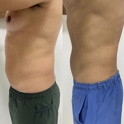 Antes e depois Slim Lipodetox®