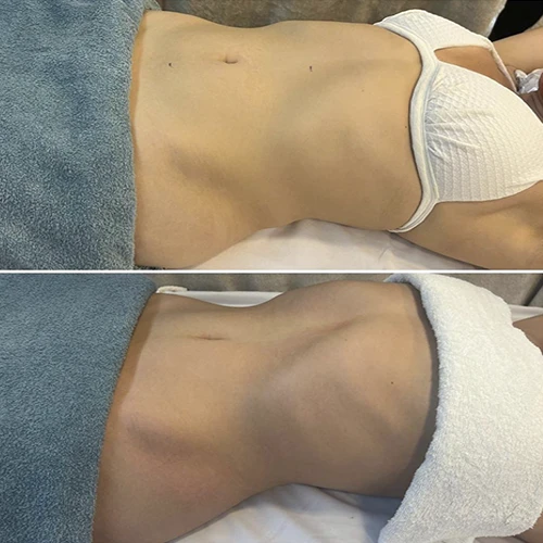 Antes e depois Slim Lipodetox®