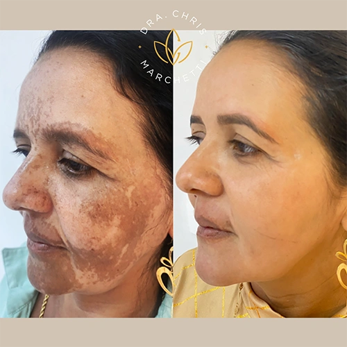 Antes e depois de tratamento de melasma