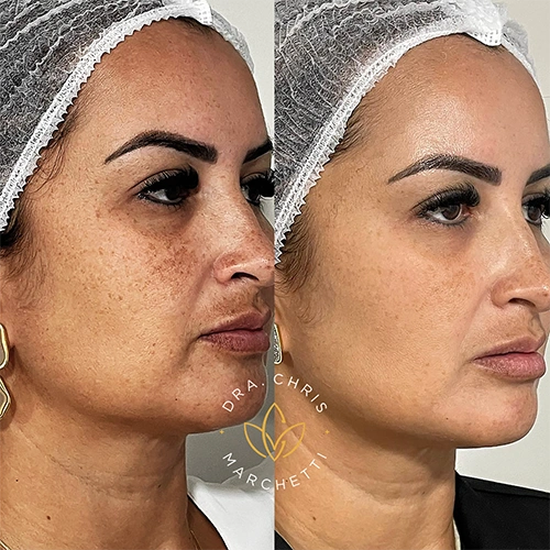 Antes e depois de tratamento de melasma